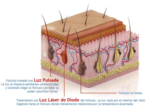 Depilación láser de diodo, el método efectivo, indoloro y garantizado