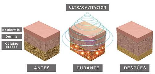 ultracavitacion