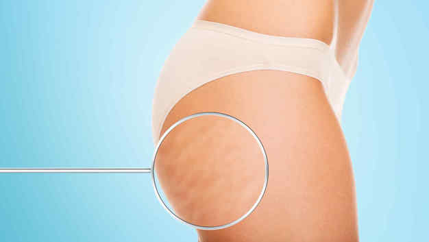 ¿Deseas eliminar la celulitis rápidamente? ¡Aquí te decimos cómo!